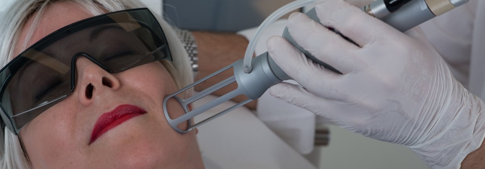 Aknenarben entfernen mit dem fraktionierten CO2 Laser bei Dermacare 1010 Wien