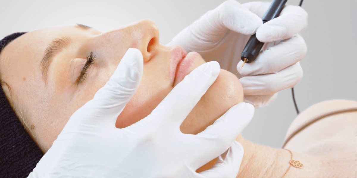 Nadelepilation gesicht Dermacare