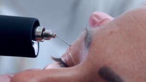 Plamapen bei Dermacare 1010 Wien 3