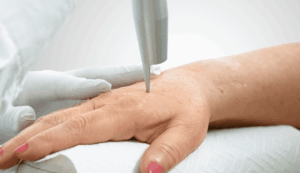 altersflecken entfernen wien dermacare altersflecken auf hand