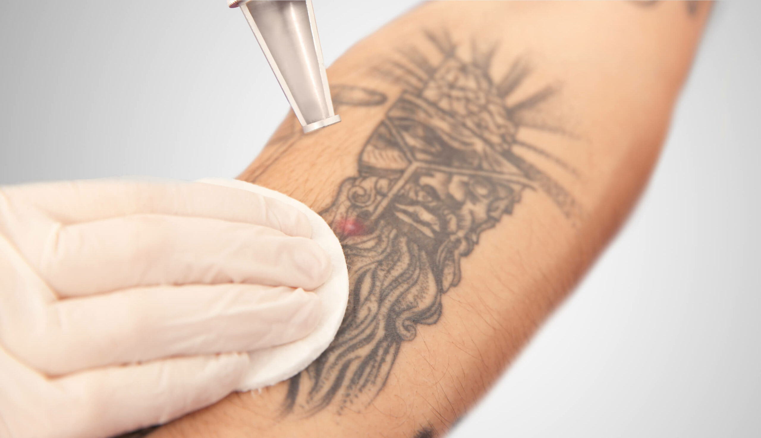 arm Tattooentfernung dermacare cover up tattoo vorbereitung 1 scaled