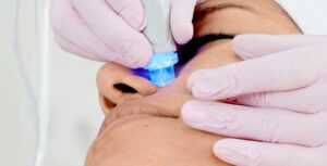 Auf diesem Bild sieht man wie die Aquafacial Tiefenreinigung von Dermacare Wien durchgeführt wird.