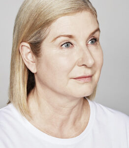 Fadenlifting hyaluronsaeure wien nachher catherine 567x650 1