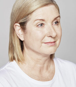 Fadenlifting hyaluronsaeure wien vorher catherine 567x650 1