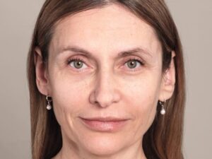 Faltenbehandlung mit Hyaluron in Wien bei Dermacare Nachher 866x650 1