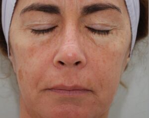 Hautstraffung Hautverjuengung Entfernung Pigmentflecken mit CO2 Laser Fraxel Gesichtsfalten bei Dermacare 1010 Wien Vorher