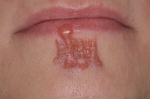 Narben entfernen bei dermacare 1010 wien vor behandlung