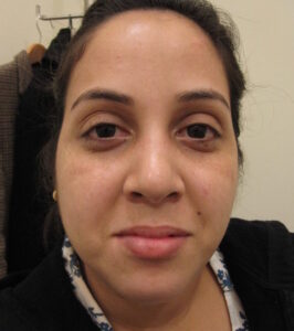 Pigmentfleck gesicht2 nachher 576x650 1