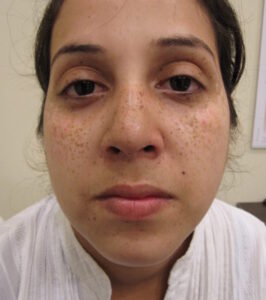 Pigmentfleck gesicht2 vorher 576x650 1