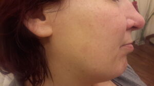 Pigmentfleck gesicht nachher