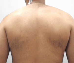 Vorher bilder laserhaarentfernung dermacare ruecken