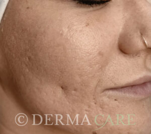 akne nachher TCA peeling wien dermacare 733x650 1