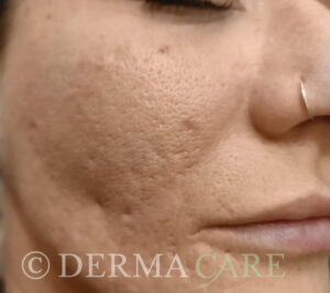 akne vorher TCA peeling wien dermacare 733x650 1