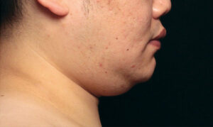 coolsculpting kinn vorher Dermacare Wien mann