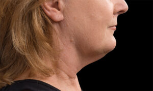 coolsculpting wien dermacare wien doppelkinn nachher frau 2