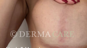 hautverjuengung stammzellen brust nachher bild stammzellentherapie 1163x650 1