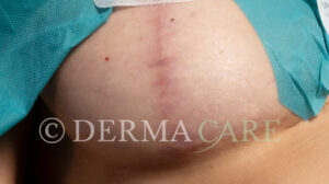 hautverjuengung stammzellen brust vorher bild stammzellentherapie 1163x650 1