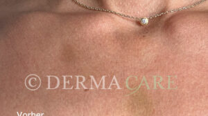 hautverjuengung stammzellen dekollete vorher bild stammzellentherapie 1163x650 1