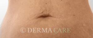 nachher bauch dehnungsstreifen entfernen schwangerschaftsstreifen entfernen wien dermacare 1582x650 1