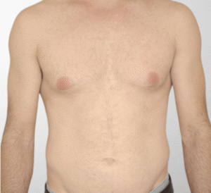 nachher bild laserhaarentfernung brust dermacare