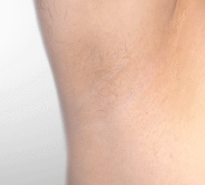 nachher laserhaarentfernung achsel dermacare
