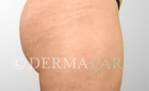 radiofrequenz microneedling dehnungsstreifen bein nachher 1065x650 1