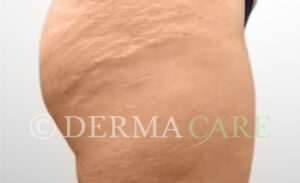 radiofrequenz microneedling dehnungsstreifen bein vorher 1065x650 1