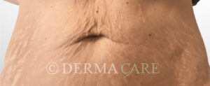 vorher bauch dehnungsstreifen entfernen schwangerschaftsstreifen entfernen wien dermacare 1582x650 1